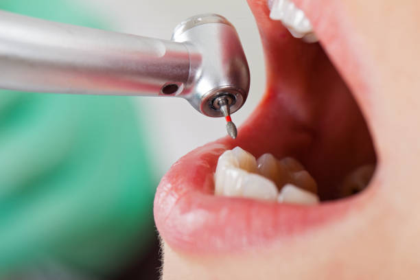 Best Emergency Root Canal Therapy in Alma, MI